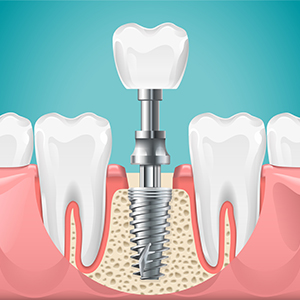 Invisalign West Chester